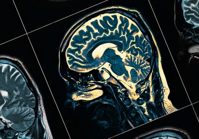 MRI scan of a human head in profile