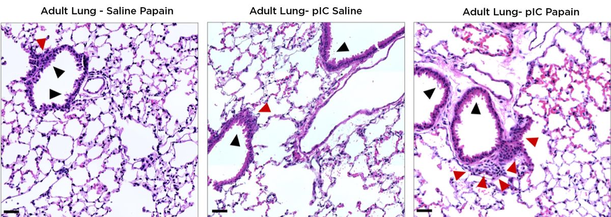 Histopathological images of lungs from adult mice treated either with the allergen papain as adults (left), exposed to an inflammatory stimulus in utero without adult papain treatment (middle), or exposed to prenatal inflammation and treated with papain. Prenatal inflammation and papain individually cause thickening of airway lining, visualized by increased purple and pink staining, and this is worsened with the combined treatment.