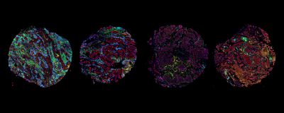 Four circular maps of color-coded immune cell types corresponding to the four tumor microenvironment archetypes.