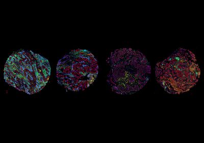 Four circular maps of color-coded immune cell types corresponding to the four tumor microenvironment archetypes.