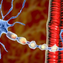 3D illustration of damaged myelin sheath seen in demyelinating diseases such as multiple sclerosis.