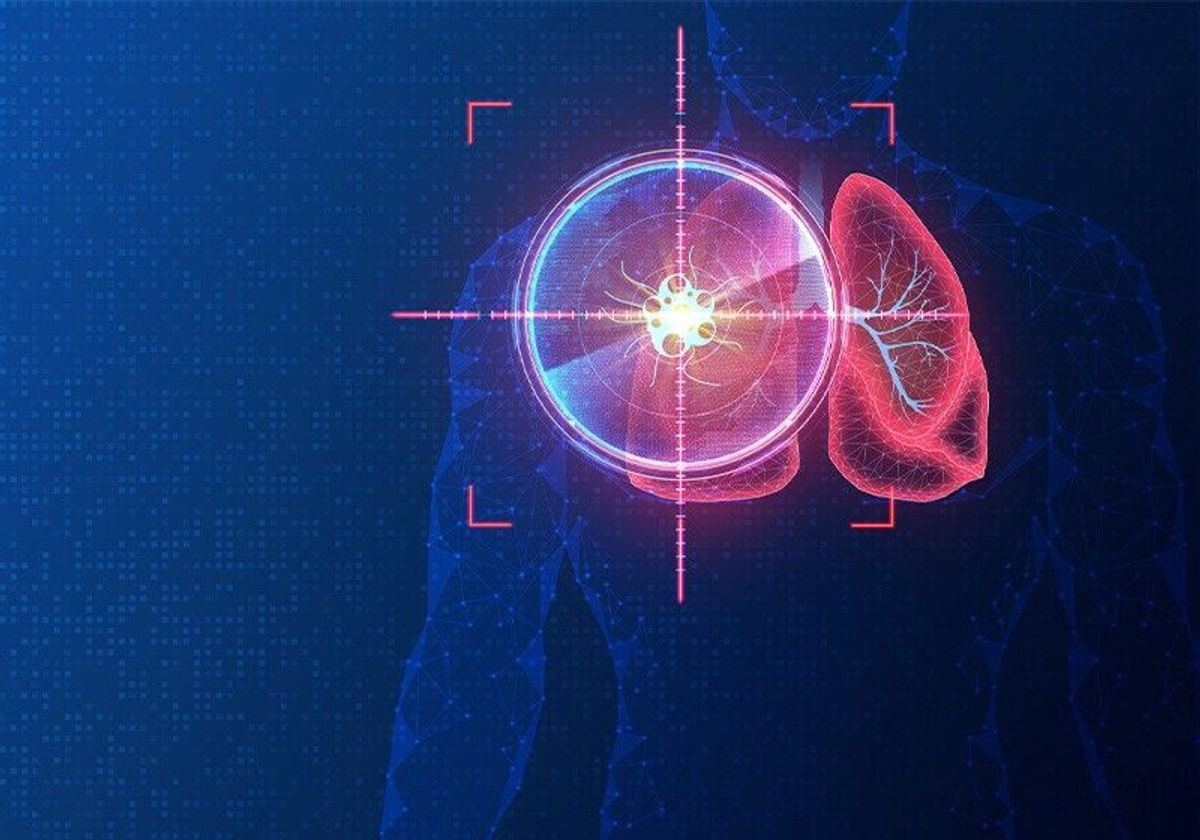 A red target sits over a lung tumor on the outline of a person.