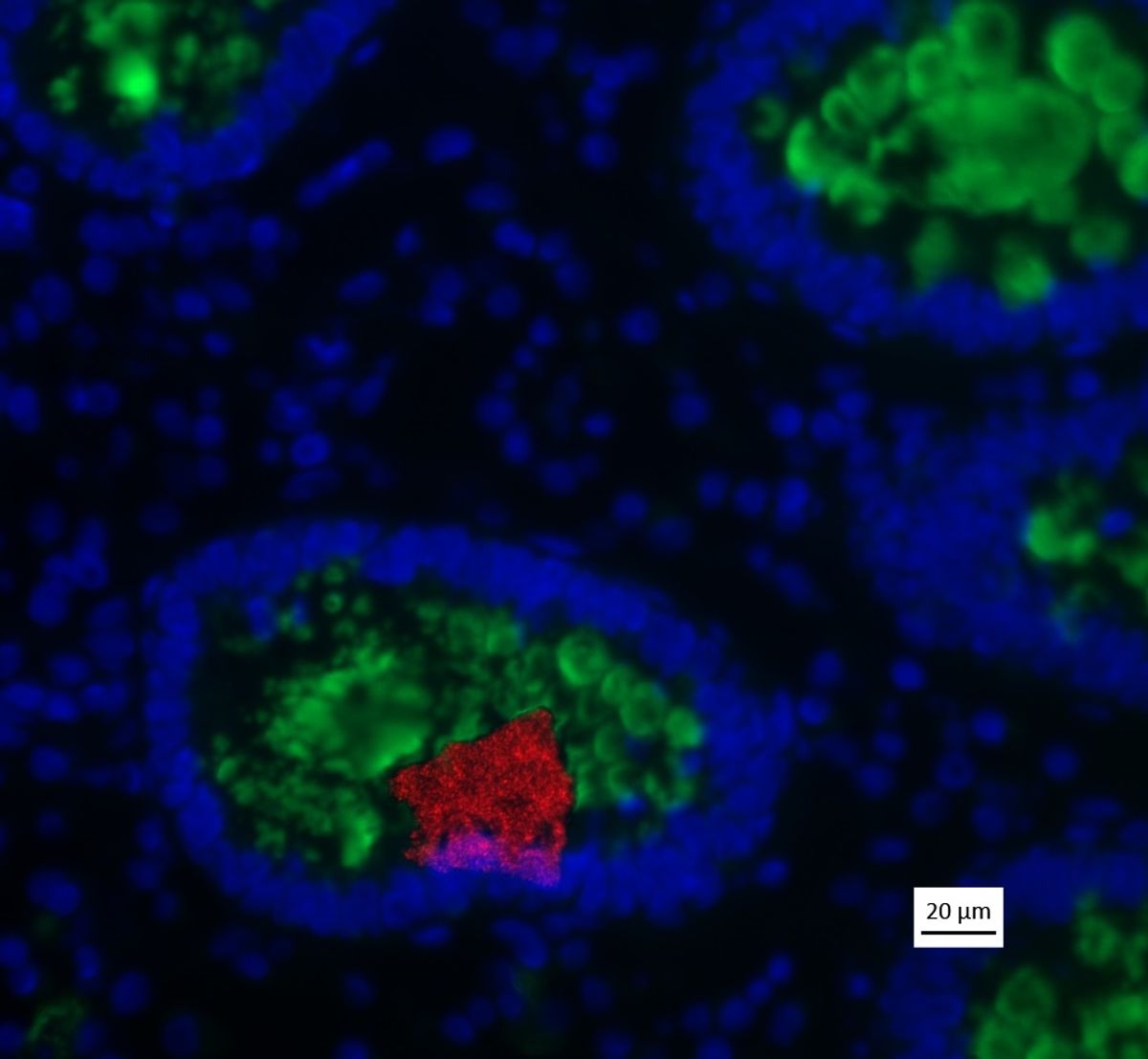 A fluorescent microscopy image of periappendicular bowel shows a group of red-labeled bacteria cells embedded in a rough oval of green-labeled mucus tissue, encased in a ring of blue-labeled epithelial cells.