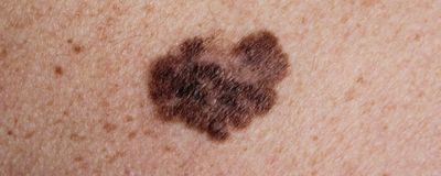 A melanoma on human skin.