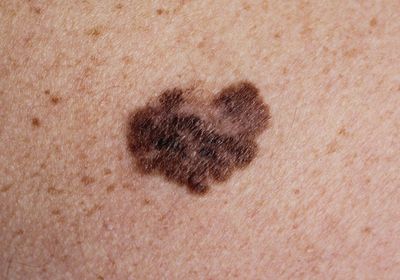 A melanoma on human skin.