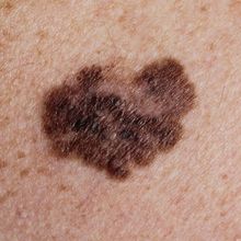 A melanoma on human skin.