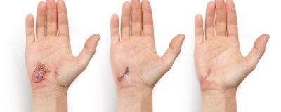 Three images of a hand with an abrasion progressing from most recently injured (left) to most healed (right).