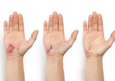 Three images of a hand with an abrasion progressing from most recently injured (left) to most healed (right).