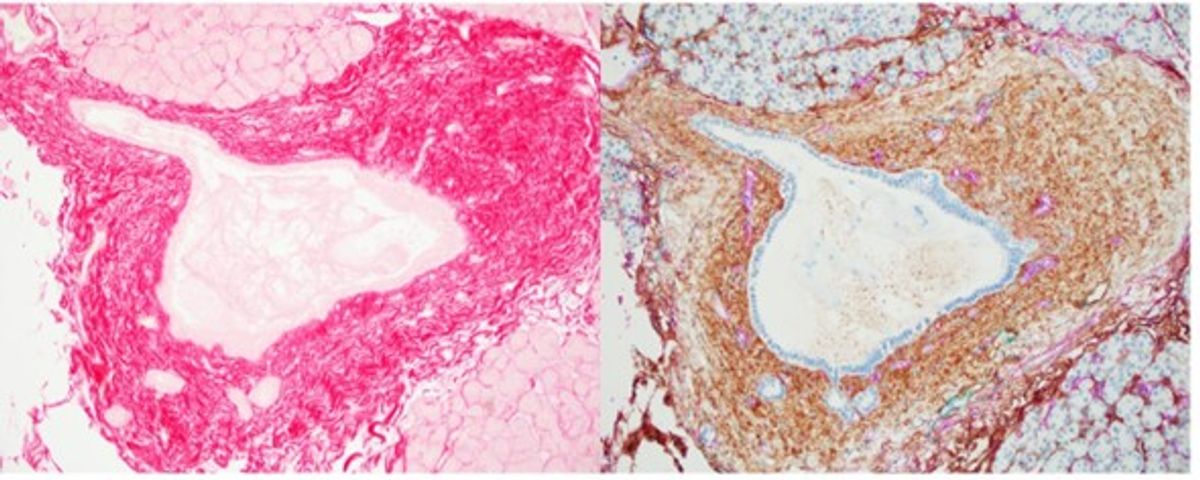 Histopathological cross sections of human pancreas tissue showing red and brown stains for collagen and hyaluronic acid, respectively.