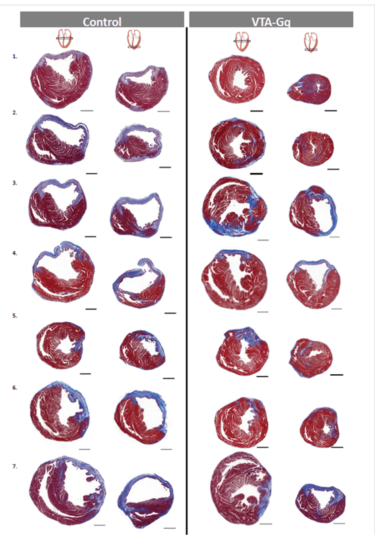 Several cross-sections of blue and red heart tissue are shown, indicating areas of fibrosis and muscle tissue.